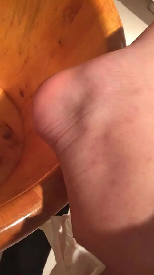 右脚脚踝内侧有一块骨头突出 很小的时候崴过一次 最近开始偶尔有点疼
