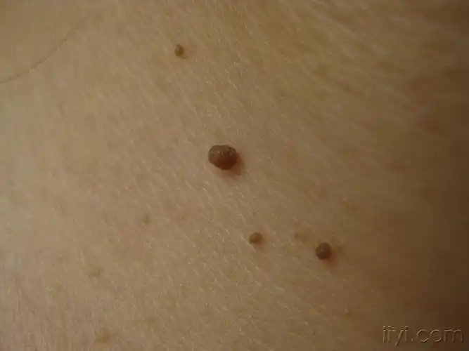 看看这些赘生物是什么如何治疗