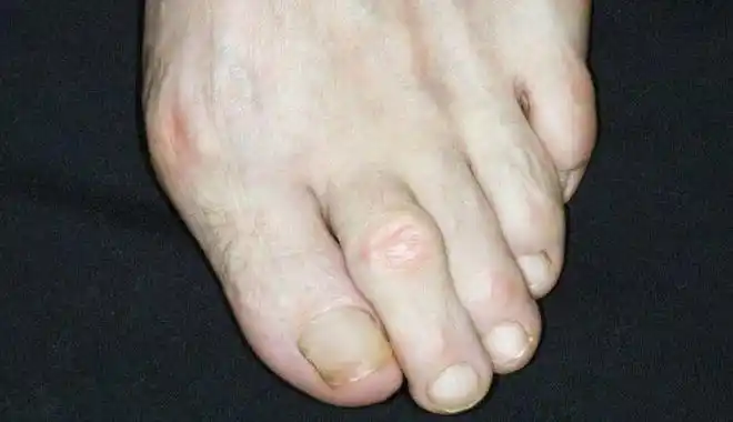 距离"癌细胞"有多远,脚趾头先知道,如有这3种变化,请警惕!