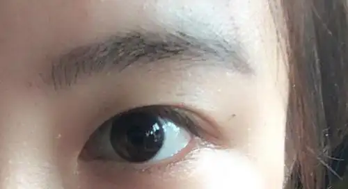 内眦也太严重了!