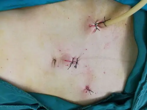 肚子大疙瘩没啦!