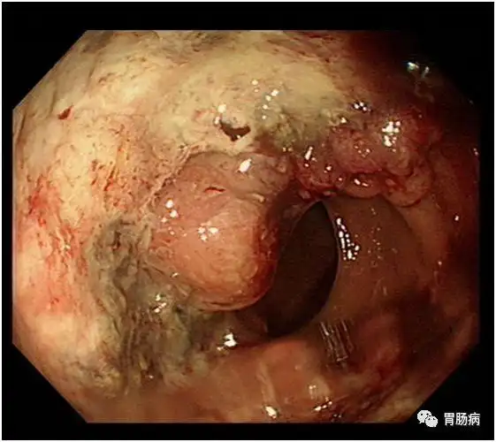大便出血当痔疮50岁阿姨直肠癌晚期这样的肠镜检查还要经历多少