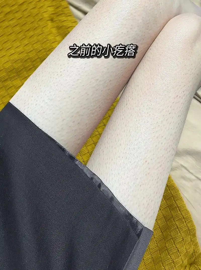 尿素霜去鸡皮 #毛孔堵塞 #鸡皮肤怎么去除最有效 #身体乳 - 抖音