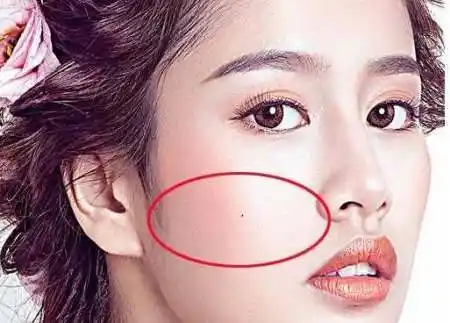 女人面部痣解析