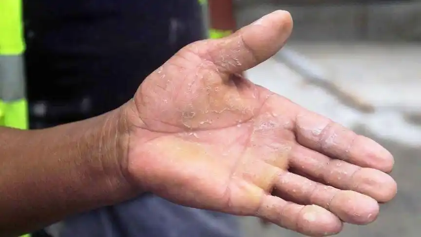 手上茧子太多?可别拿剪刀去剪了,教你一招,轻松除掉手上茧子!