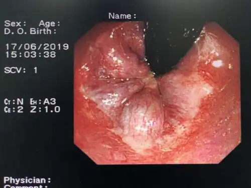 有"痔"者的福音:内镜下内痔泡沫硬化术