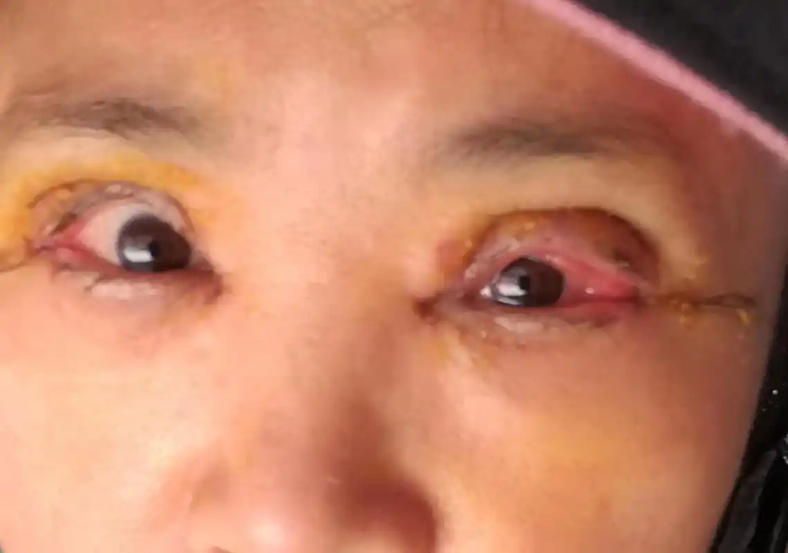 术后半个月每个夜晚眼睛疼得豁豁的,各种肿胀痛,右眼不见好转, - 抖音