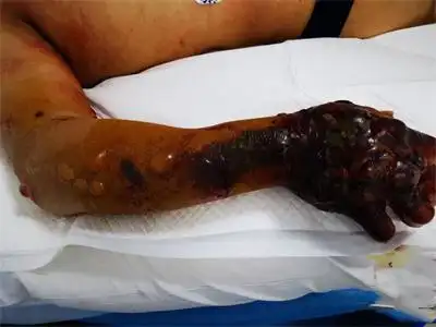 宁夏第四人民医院消化内科成功救治1例罕见重症皮肤炭疽__凤凰网