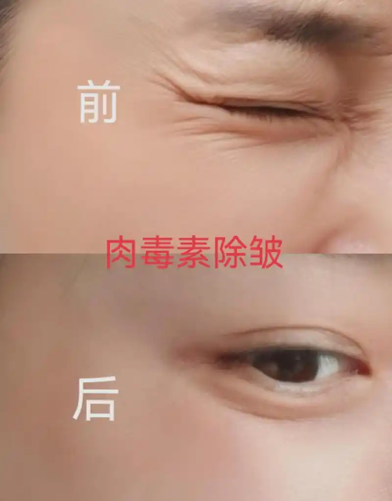 鱼尾纹打肉毒素是可能会出现副作用的,主要是表情僵硬不自然,两侧