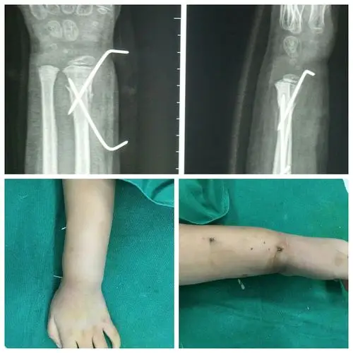 一例6岁儿童桡骨陈旧性骨折