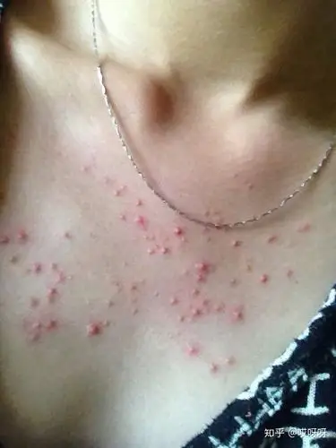 哪些因素会导致胸口长痘痘