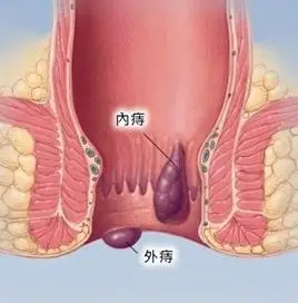 而外痔一般都无任何症状的,会有肛门坠胀不适,一但出现血栓,水肿时