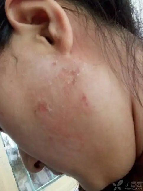 右前臂屈侧皮损(貌似沿肌腱走行) [病例帖]