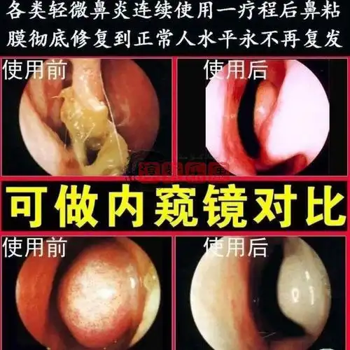 鼻炎贴鼻过敏性鼻炎嗅觉减退头昏记忆力减退一盒6贴体验装鼻炎贴