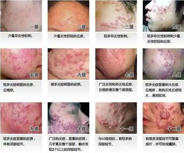 炎症丘疹型痘痘图片,不及时治疗会发展成脓包留疤