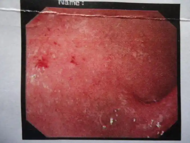 胃镜诊断结果:反流性食管炎,糜烂性胃炎,十二指肠球部霜斑样溃疡.