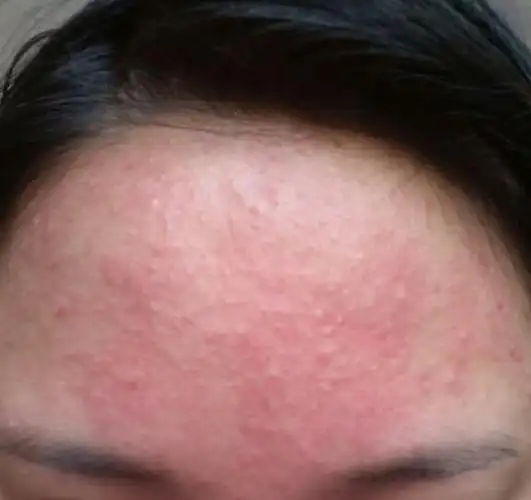 这是痘痘还是过敏呀,一直在用痘痘的药