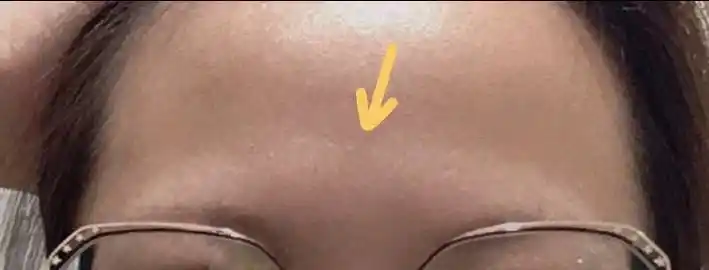 感觉有跟骨头突出在额头上,这种适合去填充额头吗