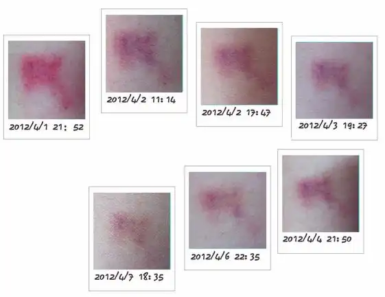 淤青的颜色为什么会变化?