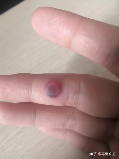 液氮冷冻治疗手指上的寻常疣