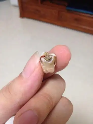 医生说剩下1mm的牙根在里面,如果要清除创伤很大,留着没问题的.请问这