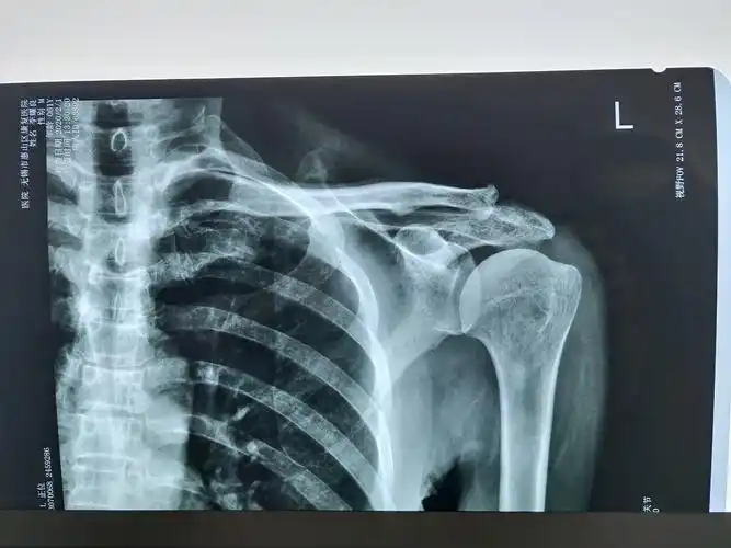 突发肩锁关节剧痛会是痛风性关节炎吗?