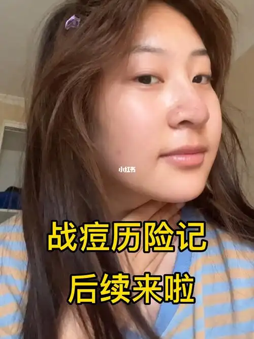 囊肿性痘痘后续来啦