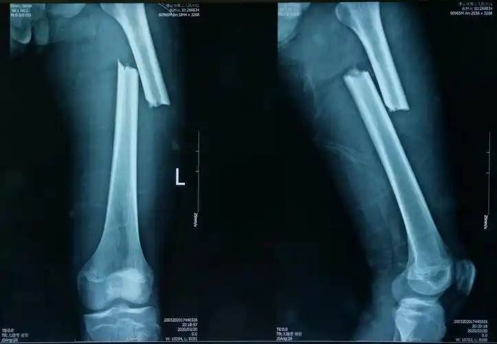 股骨干骨折闭合复位髓内钉内固定手术一例