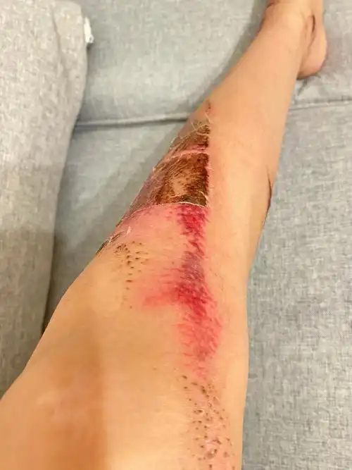 腿部大面积擦伤疤痕掉痂的地方是紫红色