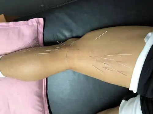 孟铎扎满银针的左腿