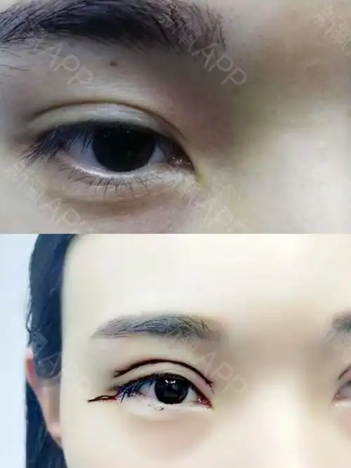 菲林切开双眼皮77开外眼角手术术后第一天73