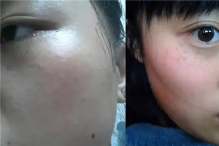 颧骨母斑属于什么病 激光手术疗效好