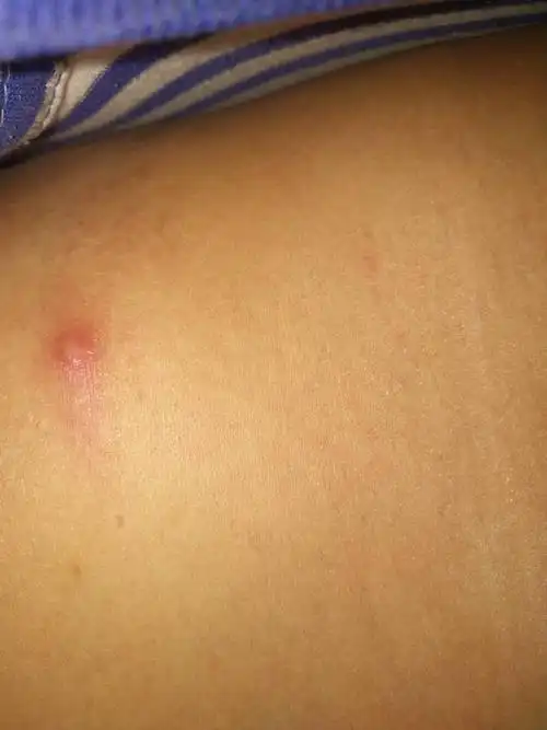 肩膀上长个包一压就痛