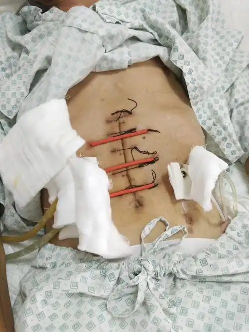 一例(患者是三无人员)胃大部切除术后十二指肠残端瘘 切口感染处理