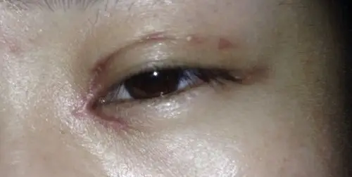 做完开眼角,双眼皮一个月疤痕明显是失败了吗?现在是这样的,求医生_百