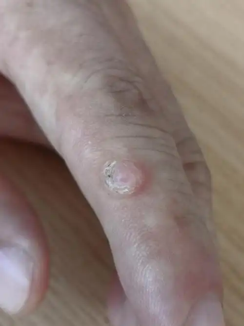 解决皮肤问题专注皮肤美容##寻常疣