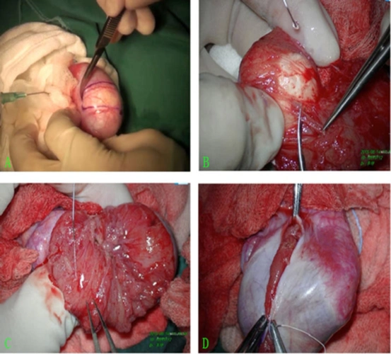 下图:显微镜保留睾丸的睾丸肿瘤切除术.