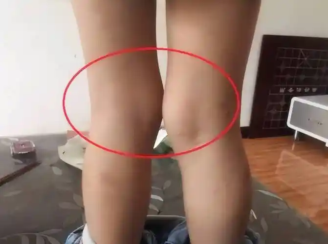 这个姿势是不会对孩子腿型发育造成负面影响的,相反,通过绑腿等方式