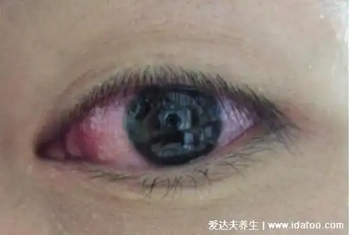 真实初期红眼病图片及症状,眼睛发红眼屎又黏又多(会传染)
