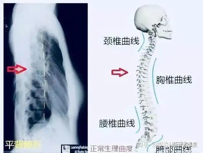 正常脊柱呈s型生理曲度,每个部分都有它自己的生理曲度,这些正常生理