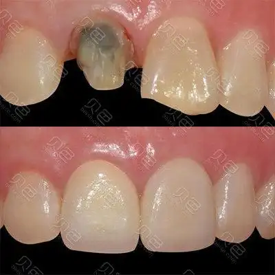 全瓷牙修复前后对比