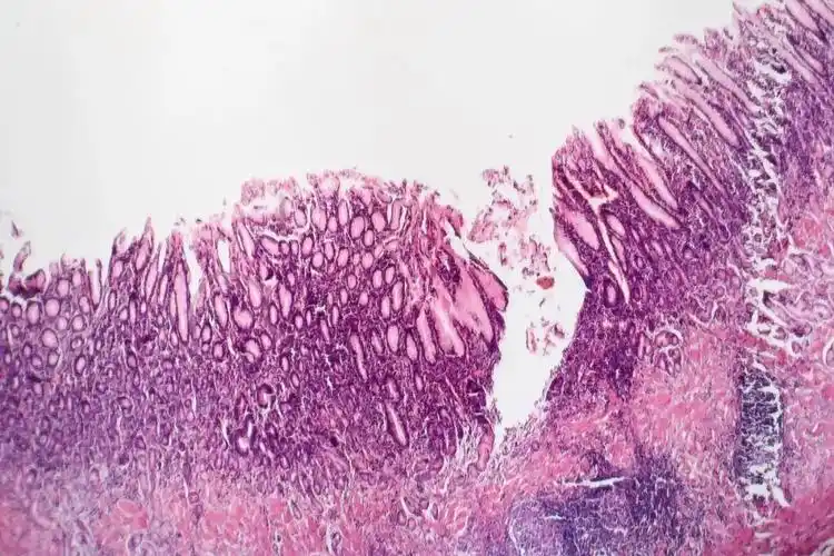 浅表性胃炎,数年或数十年后发展成为十二指肠溃疡,胃溃疡,慢性萎缩性