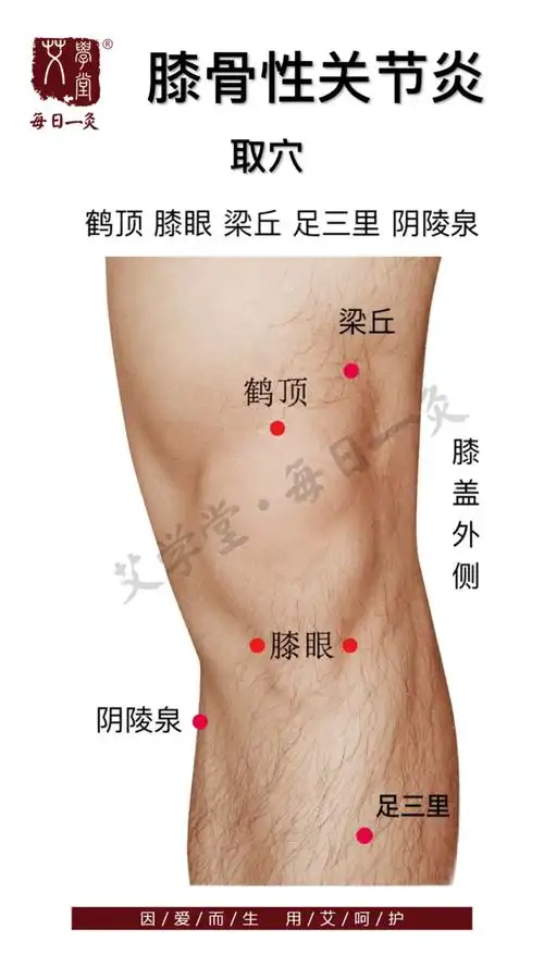膝骨性关节炎 艾灸