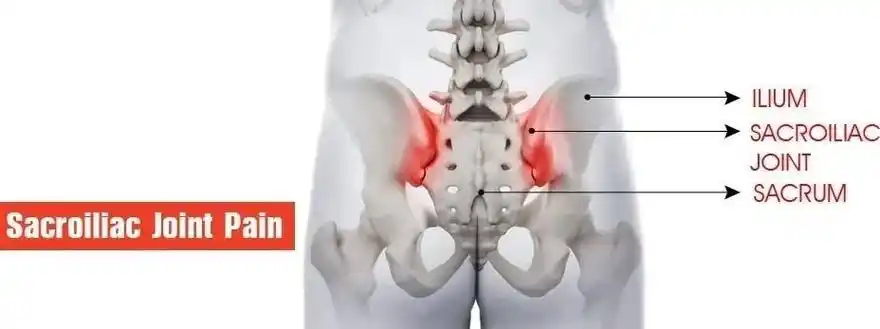 腰痛之骶髂关节疼痛的原因及运动恢复
