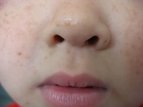 囊性纤维病的病因