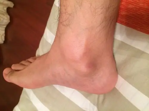 您好今天发现我的脚踝处骨头下面有一块突出的骨头触摸无疼痛