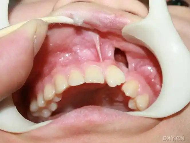 【求助】牙槽嵴裂术中的照片