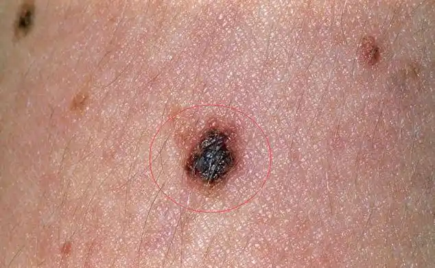 长毛的痣会癌变吗?