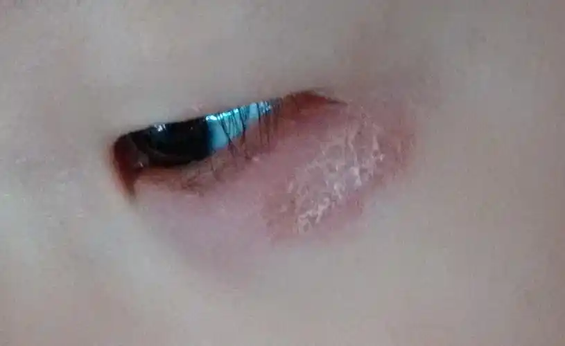 2岁小孩下眼皮红肿破皮流脓数月前开始的用药后有好转持续