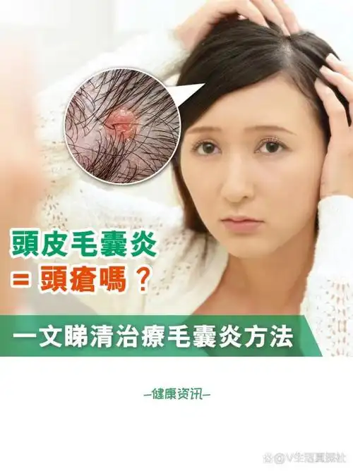 头皮毛囊炎=头疮吗71治疗毛囊炎有什么方法71